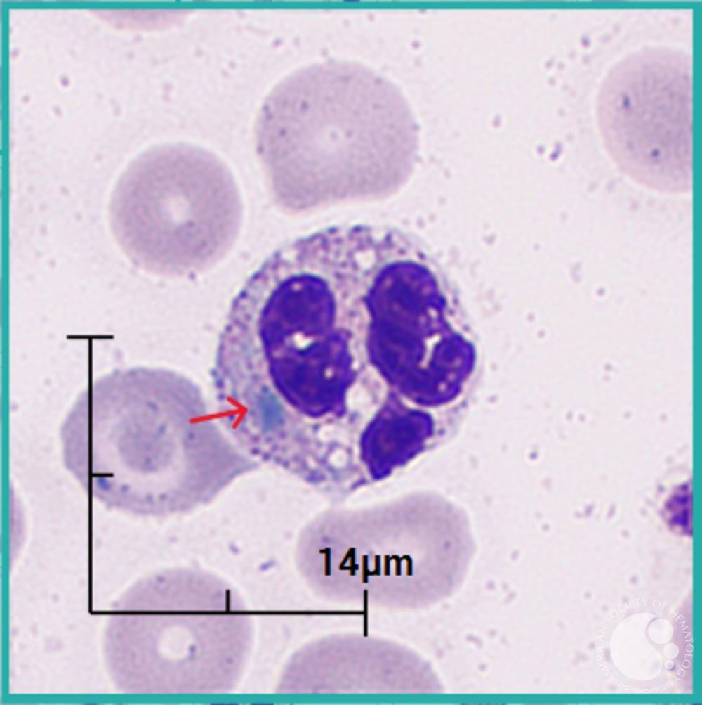 <p>What <strong>ribosomal RNA</strong> inclusion found in <strong>neutrophils </strong>can sometimes be seen during toxic granulations? </p>