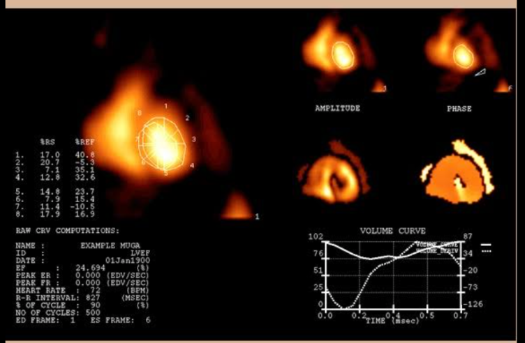 <p>evaluates ventricular function, cardiac wall motion, ejection fraction, and cardiac output after the injection of albumin or red blood cells (RBCs) labeled with a radionuclide (technetium Tc 99m).</p>