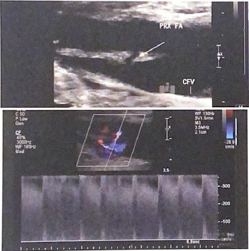 <p>The following B-mode image and spectral doppler tracing are from a lower extremity arterial exam. there appears to be a connection between the artery and adjacent vein. what condition is present in this lower extremity? Describe what evidence from the spectral tracing supports your interpretation.</p>