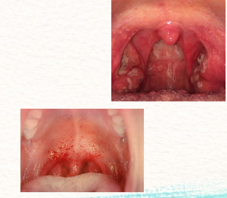 <p><strong>Symptoms of Group A Beta Hemolytic Strep Tonsilitis/Pharyngitis </strong></p><p>-_____</p><p>-Tender anterior cervical adenopathy</p><p>-Pharyngotonsillar _______, not as common as people may think</p><p>-Erythematous ____________, which causes a severe sore throat</p><p>-Palatial petechiae, which are bright red dots around the uvula and soft palate</p>