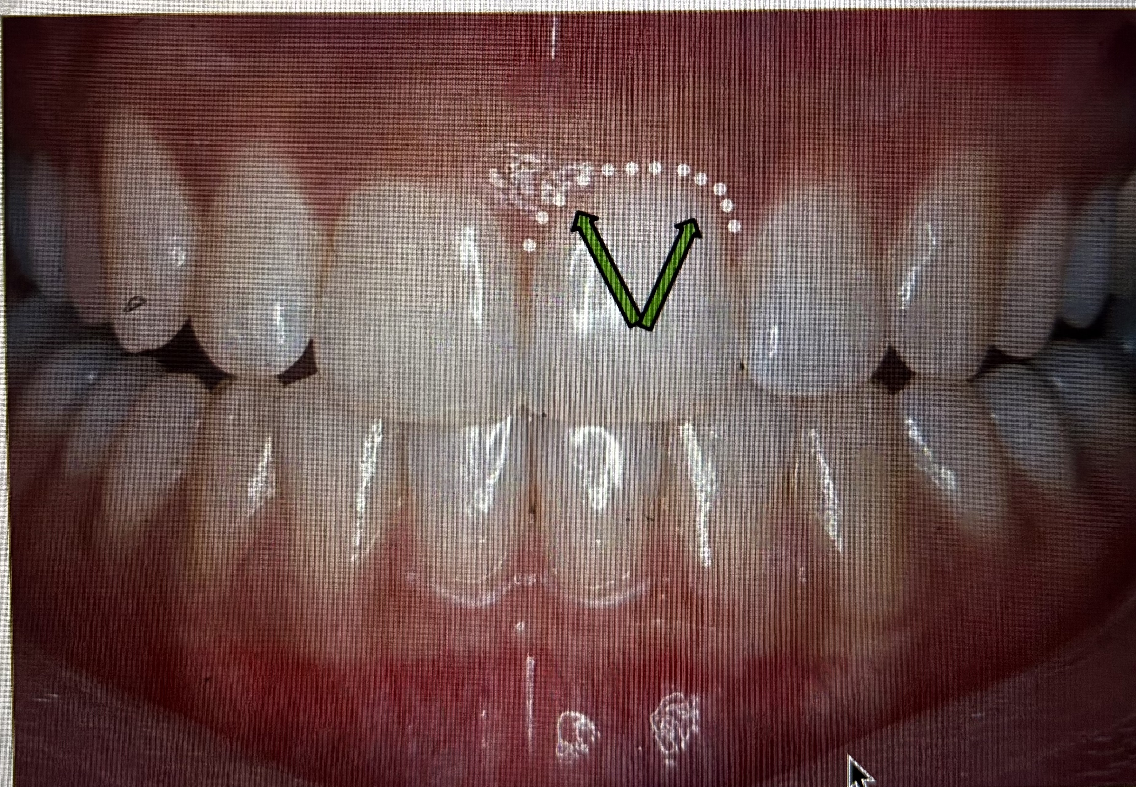 <p><span><span>What part of the gingiva is the arrow pointing to?</span></span></p>