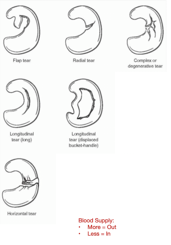 <ul><li><p>Longitudinal </p><ul><li><p>Associated w ACL tears</p></li></ul></li><li><p>Bucket Handle</p><ul><li><p>Progression of Longitudinal Tear </p></li></ul></li><li><p>Horizontal</p><ul><li><p>Moves inside to outside of meniscus </p></li></ul></li></ul><p></p>
