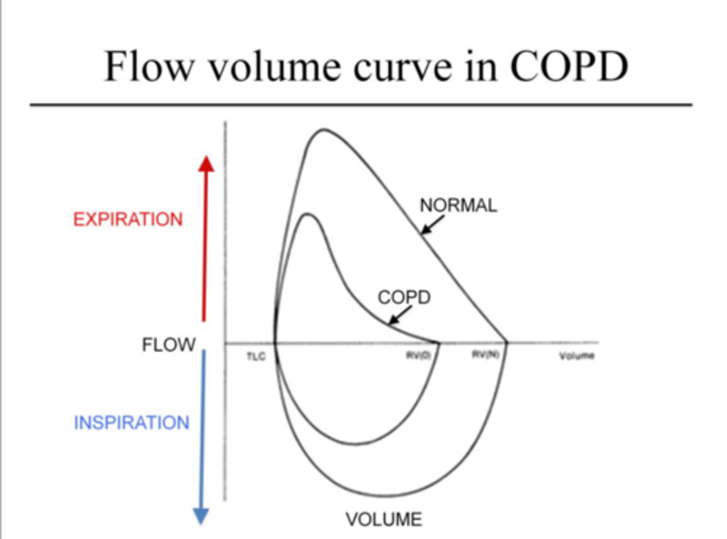 <p>- severe limitations with expuratioins (top of loop)</p><p>- lower PEF</p><p>- major scooping: imparment in max expiratory flow... leads to:</p><p>- Much wer FEV1 --> FEV1/FVC <0.7</p><p>why?</p><p>1. airway narrowing --> ↑ resistance</p><p>2. loss of elastic recoil/very compliant</p>