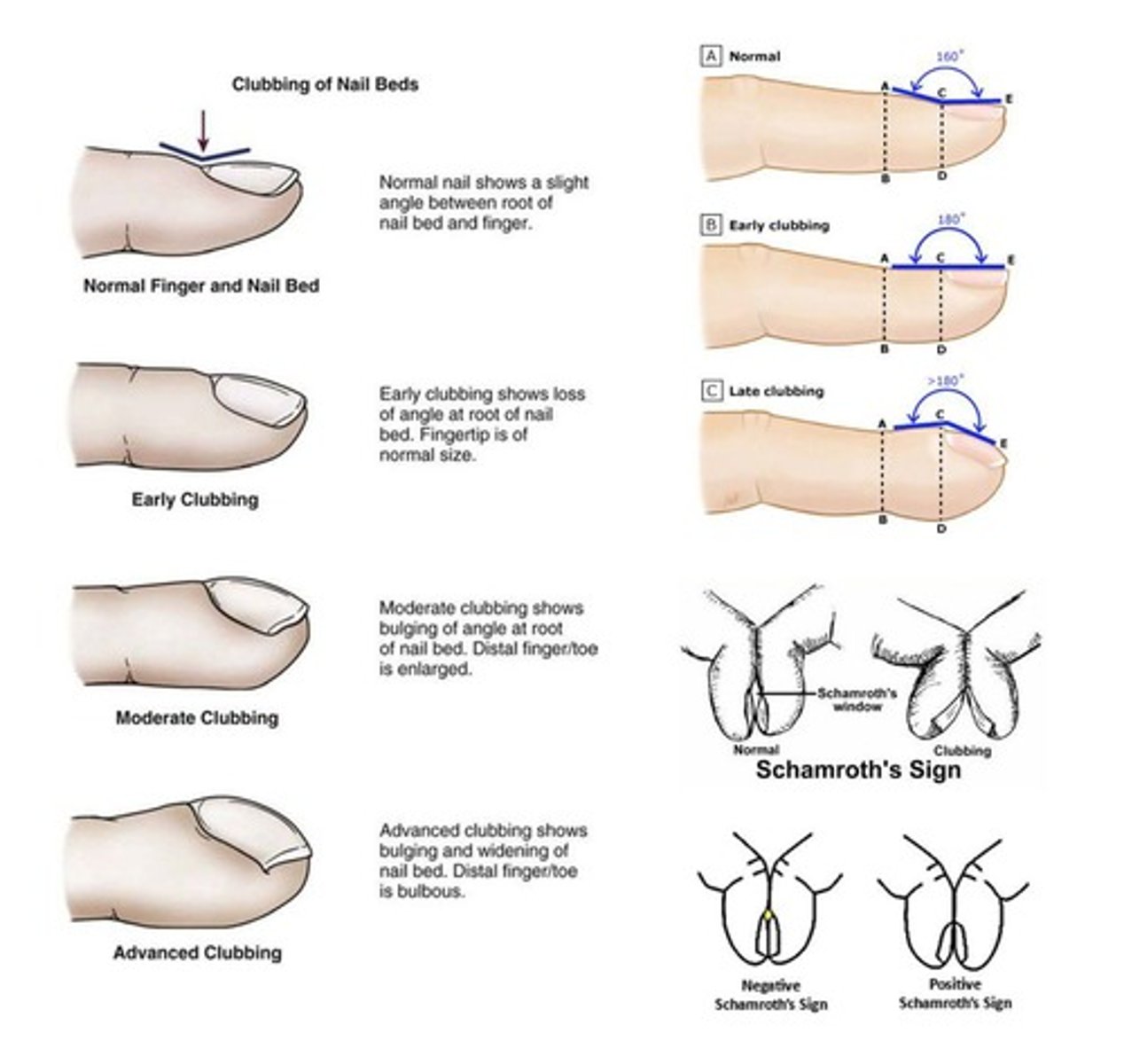 <p>A physical sign characterized by the enlargement of the ends of fingers or toes.</p>