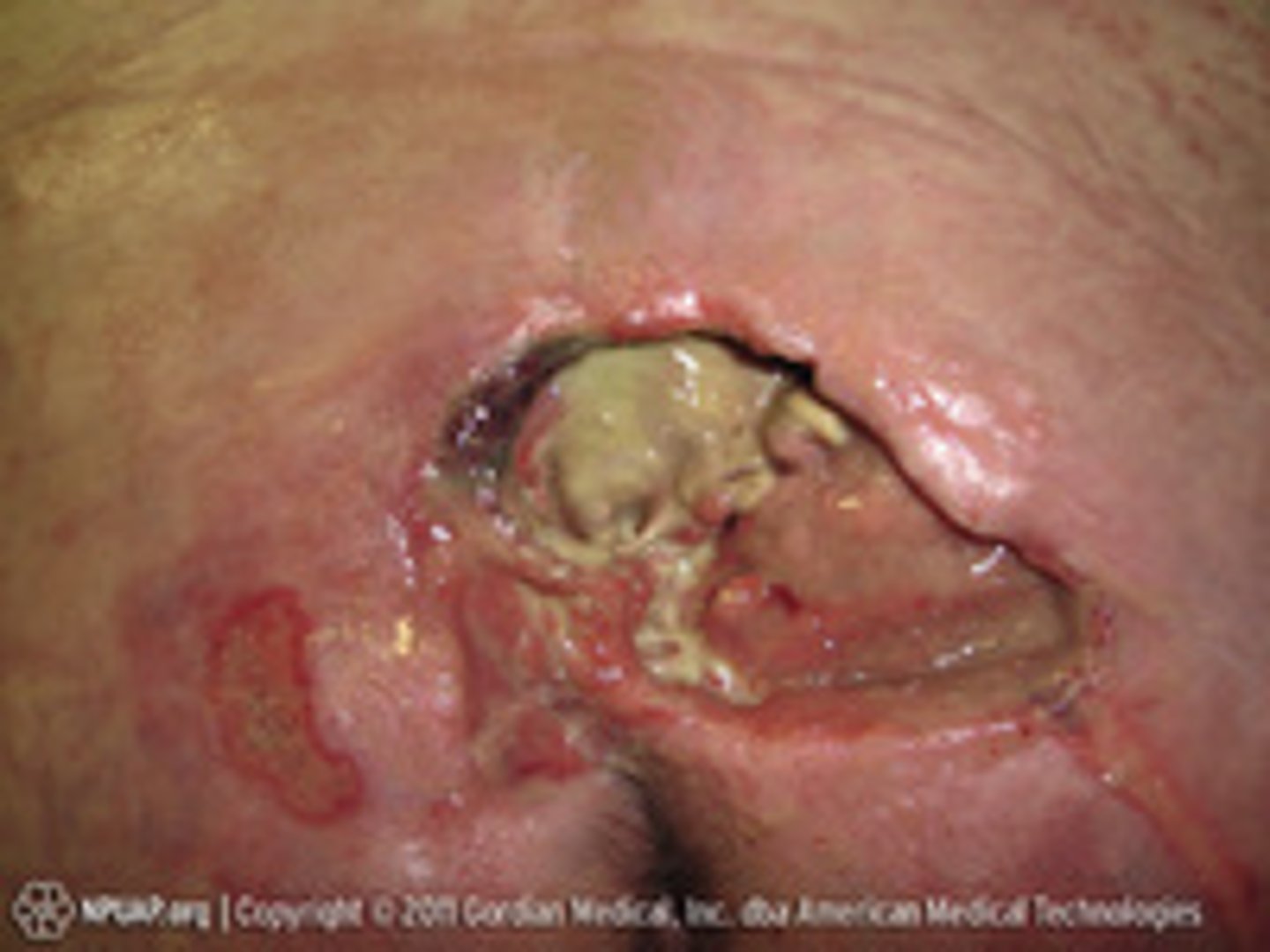 <p>i) Obscured full-thickness skin and tissue loss</p><p>ii) Base of injury covered by slough or eschar (can't see how deep)</p><p>iii) Stage 4 is present after removing slough and eschar (stable, dry adherent, eschar on heel or ischemic limb should NOT be removed)</p>