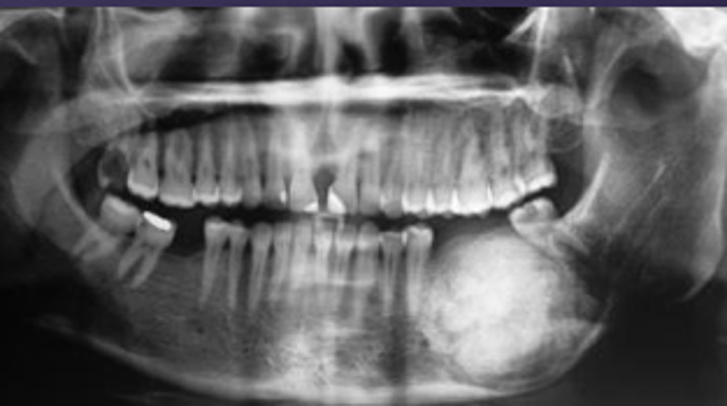 <p>ID the benign tumor:</p><p>- Radiolucent lesion, variable size, unilocular</p><p>- Radiopaque foci, radiolucent halo</p><p>- Ground glass, cotton-wool appearance</p><p>- Well-defined, "cystlike" growth-thinning of cortices</p><p>- Tooth displacement, root resorption</p>