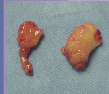 <ul><li><p>allows increased exposure to tympanic cavity </p></li><li><p>technique of choice for cats with: </p><ul><li><p>neoplasia </p></li><li><p>nasopharyngeal polyps </p></li></ul></li><li><p>better drainage of bulla </p></li><li><p><strong>cats have two compartments that make up their bulla </strong></p></li></ul><p></p>