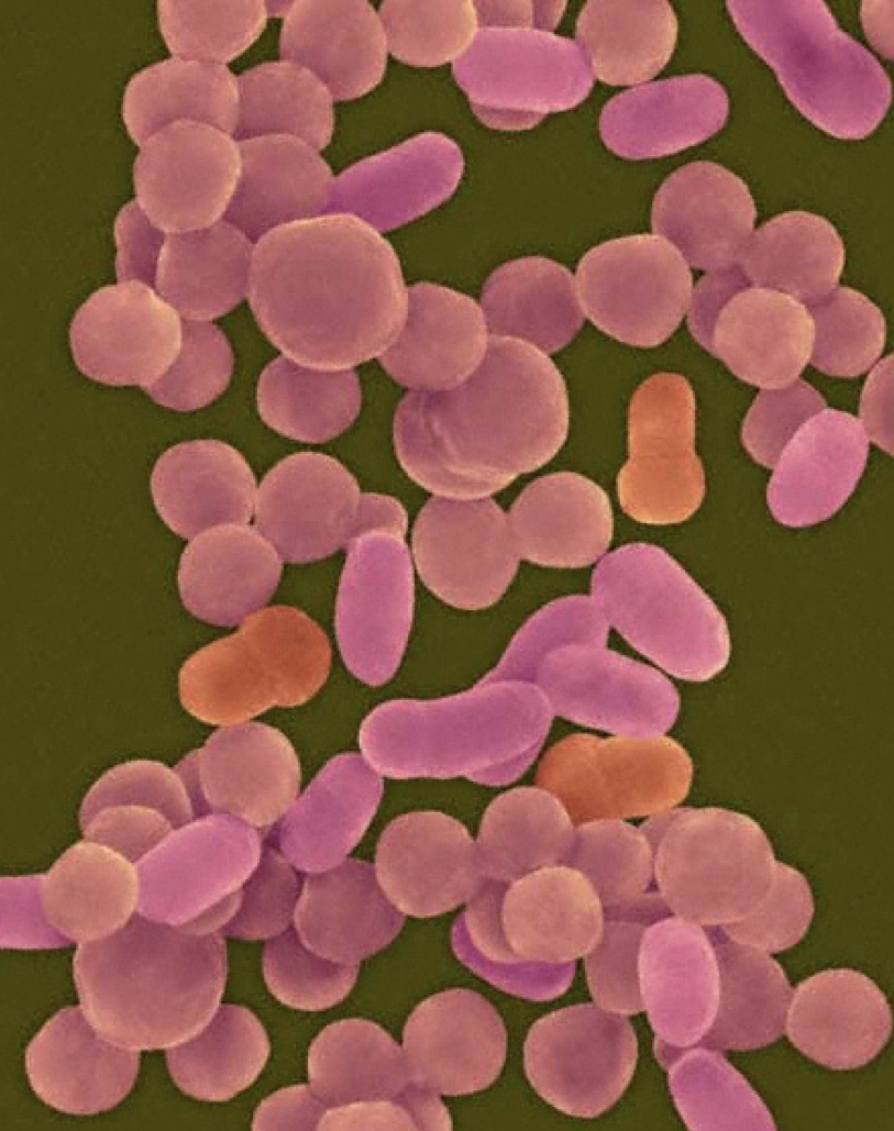 *Haemophulis influenzae* Meningitis