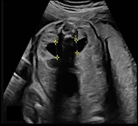 <p>when fetal <strong>hydronephrosis</strong> is suspected, how is it properly documented by US</p><p>.</p><p>a) coronal image of both kidneys, measure minimum diameter of dilation</p><p>b) transverse image w/fetal spine at 12 or 6 o’clock, measure the <strong>minimum </strong>diameter of dilation</p><p>c) transverse image w/fetal spine at 9 or 3 o’clock, measure maximum diameter of dilation</p><p>d) transverse image w/fetal spine at 12 or 6 o’clock, measure the <strong>maximum </strong>diameter of dilation</p>