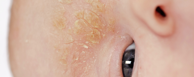 <p>ziekelijk verhoogde talgafscheiding vermengd met schilfers van de opperhuid </p>