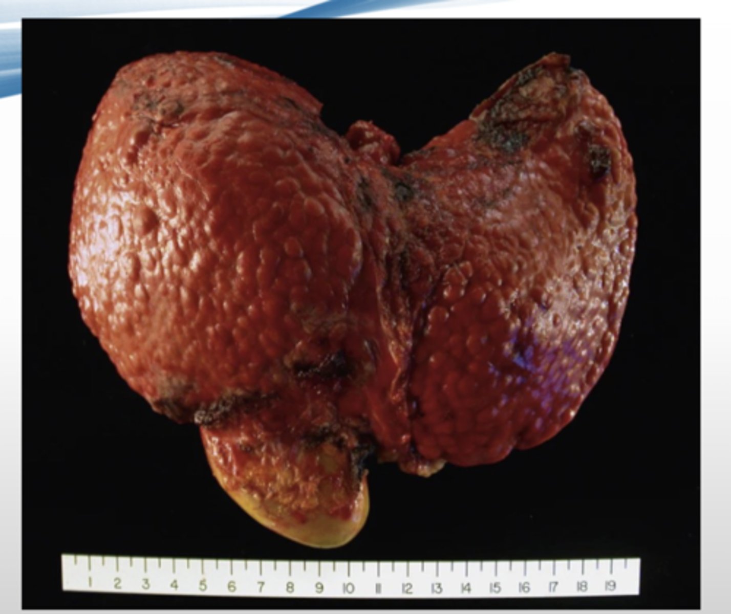 <p>enlarged liver with nodule formation</p>
