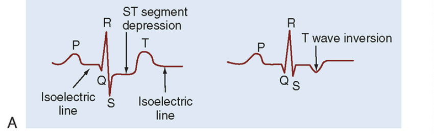 <ul><li><p><span style="background-color: transparent; font-family: "Times New Roman", serif;"><span>UA includes ST depression and T wave inversion</span></span></p></li></ul><p></p>