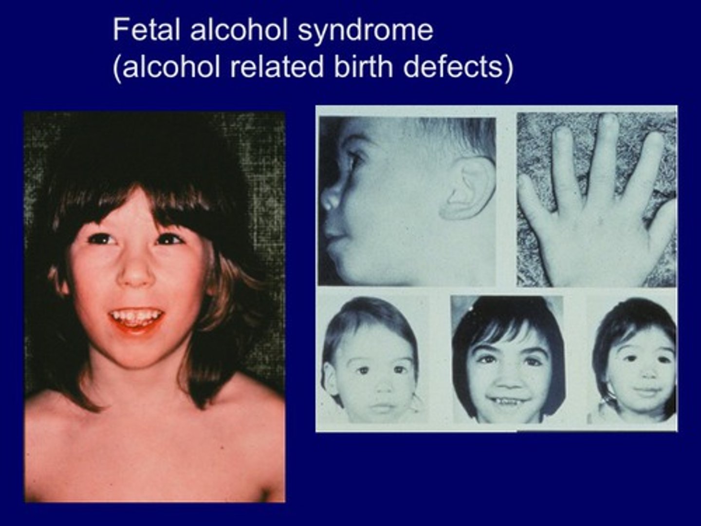 <p>alcohol is a teratogen at any stage of pregnancy, but the type of damage depends on timing and can range on a spectrum</p>