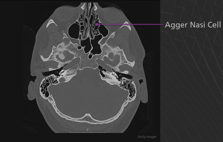 <p>Agger Nasi cell - Agger means “mound” or “heap” in Latin. This structure is the anterior-most ethmoid air cell. It is located inferolateral to the frontal recess, the channel which communicates between the anterior ethmoid and frontal sinuses. The agger nasi cell is an important landmark for front sinus surgery because the roof of the cell is the floor of the frontal sinus.</p>