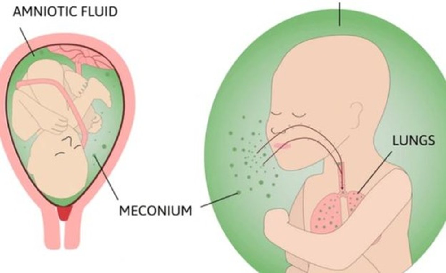 <p>Inhalation of meconium causing respiratory distress.</p>