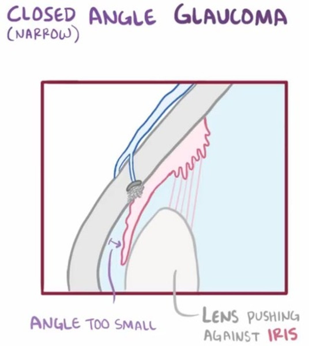 <p>1. Subacute angle closure</p><p>2. Glaucoma</p>
