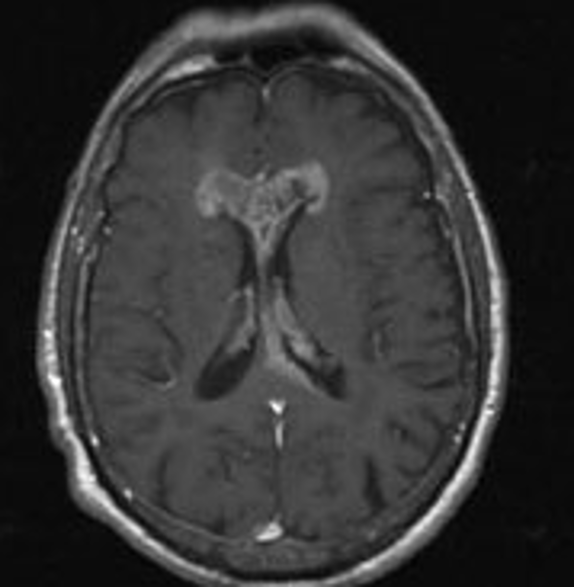 <p>tumor crossing corpus callosum</p>