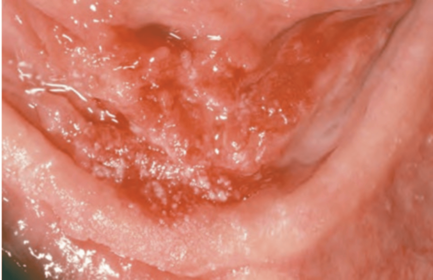 <p>Diffuse erythematous speckled plaque on floor of mouth; most likely to arise from existing leukoplakia</p>