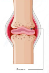<p>A thickened, inflamed layer of synovial tissue that grows over and destroys articular cartilage and bone within a joint</p>