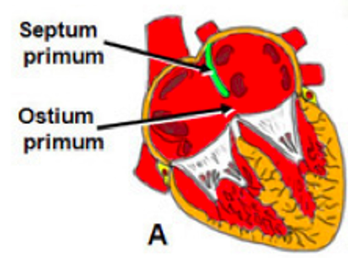 <p>- a defect in lower portion of atrial septum</p><p>- a cleft in the anterior mitral valve leaflet may cause mitral regurgitation</p><p>- common lesion seen in Down syndrome</p>