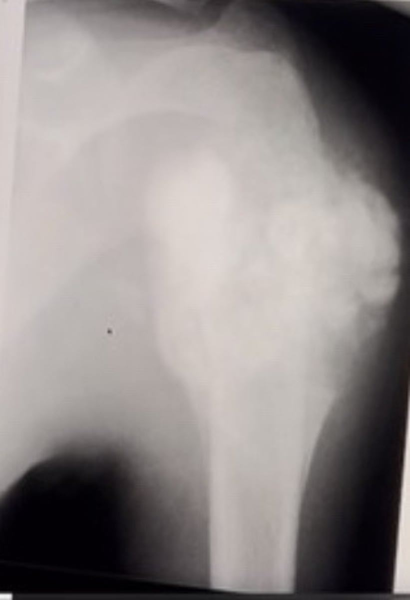 <p>13 year old male with shoulder pain.</p><p>Most likely diagnosis:</p>