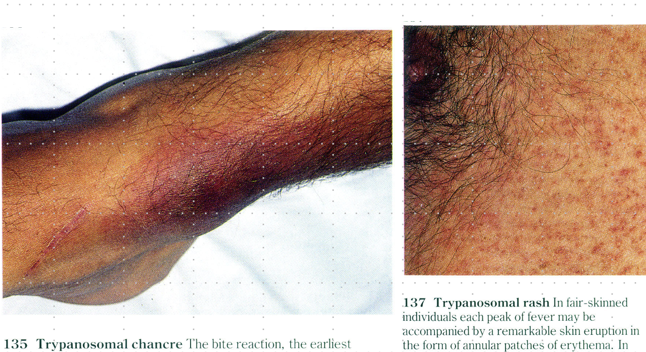 <ul><li><p>localized rxn with a chancre (a painless boil)</p></li><li><p>parasite continues dividing</p></li><li><p>5-20 days</p></li></ul><p></p>