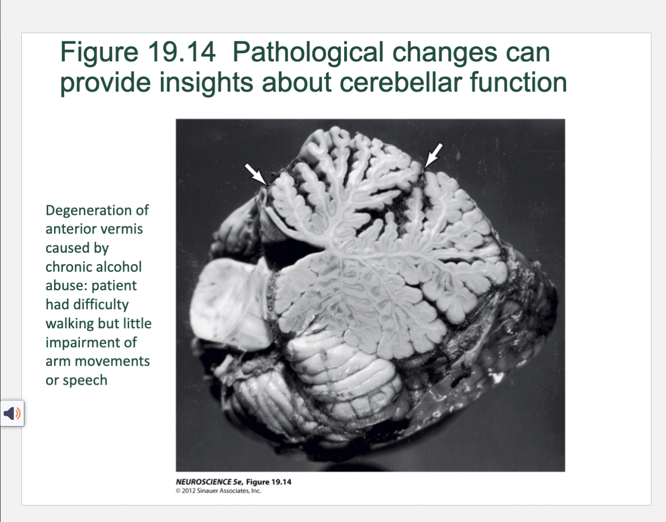 <p>Figure 19.14- Pathological Changes can provide insight into cerebellar function </p>