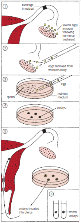 <ul><li><p>Hormones are used to stimulate the release of multiple eggs.</p></li><li><p>Eggs are surgically removed from the ovaries.</p></li><li><p>The eggs are then mixed with sperm in a culture dish.</p></li><li><p>fertilised eggs are incubated until they have formed at least eight cells.</p></li><li><p>The embryos are then transferred to the uterus for implantation.</p></li></ul><p></p>
