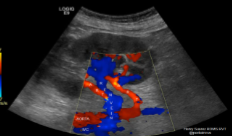<ol><li><p>What is seen in this image?</p></li><li><p>How will the sonographer doppler this image? </p></li></ol><p></p>