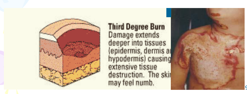 <p>Burns the skin, subcutaneous tissue, red blood cells, capillaries, and sometimes muscle are destroyed. burned skin may be white, light gray, or even charred black. Considered minor when only 2% of the body is covered.</p>