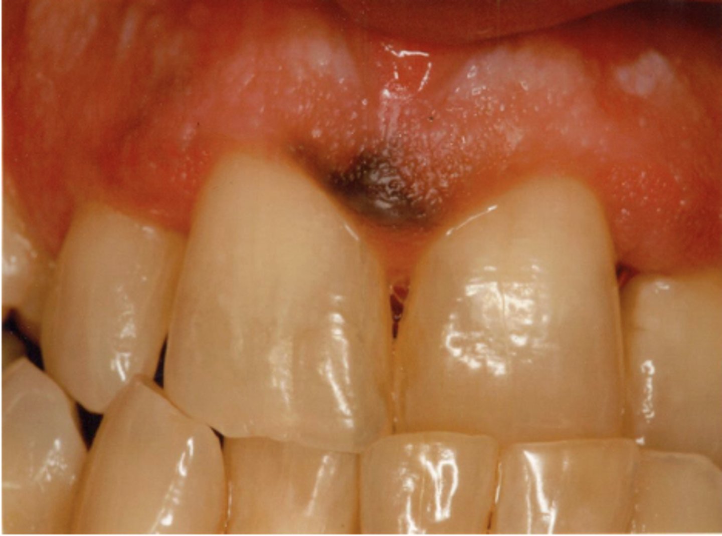 <p>What type of pigmented lesion?</p>