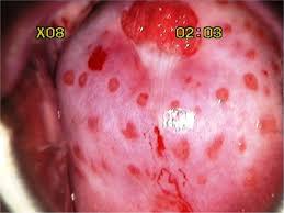 <p>Causes by : trichomonas vaginalis </p><p>symptoms: </p><ul><li><p>irrtation</p></li><li><p>green/yellow discharge </p></li><li><p>foul odor</p></li></ul><p>male -urethra infection &amp; pus </p><p>women- strawberry pattern </p><p>factors: </p><ul><li><p>lypoglycans ( TVLG) —&gt; attachment to epithelial lining </p></li><li><p>cysteine protease —&gt; induces apoptosis of epithelial cell + inflammation </p></li></ul><p></p>
