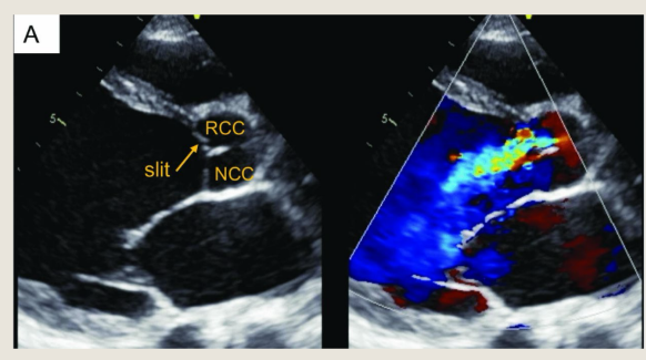 <p>Aortic leaflets can</p><p>perforate from blunt</p><p>force trauma or from</p><p>mitral valve repairs</p>