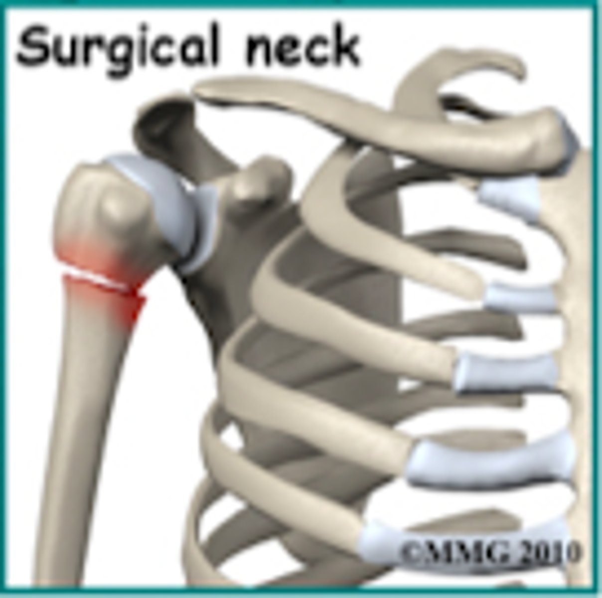 <p>2-part Fx at the surgical neck</p>