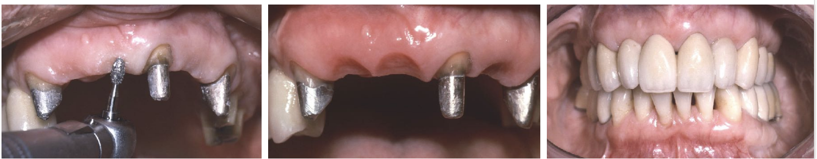 <p>a socket depression is sculpted; surgical diamonds, electrosurgery, or a dental laser </p>