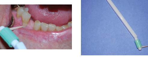 <p><strong>• Less potential for trauma</strong></p><p><strong>• Embrasure II &amp; III</strong></p><p>Proximal tooth surface where surfaces are exposed and interdental gingiva is missing, space must be enough or trauma can happen </p><p>Advantage: easy, transported easily, used more frequently than dental floss, reduce bleeding and inflammation but don’t remove biofilm as much as floss </p><p>Limitations: only for patients who follow instructions, can’t access root concavities and irregularities in proximal areas to properly removal biofilm, hard in posterior areas and from lingual aspects </p><p><strong>Procedure: </strong></p><p>fulcrum-hand on cheek or chin, or finger on gingiva </p><p>Prep-soften wood via saliva</p><p>Patient instructions: insert with tip pointed slightly up (occlusal surfaces) , move via burnishing stroke with moderate pressure and at least 4 strokes, discard as soon as splaying is seen </p>