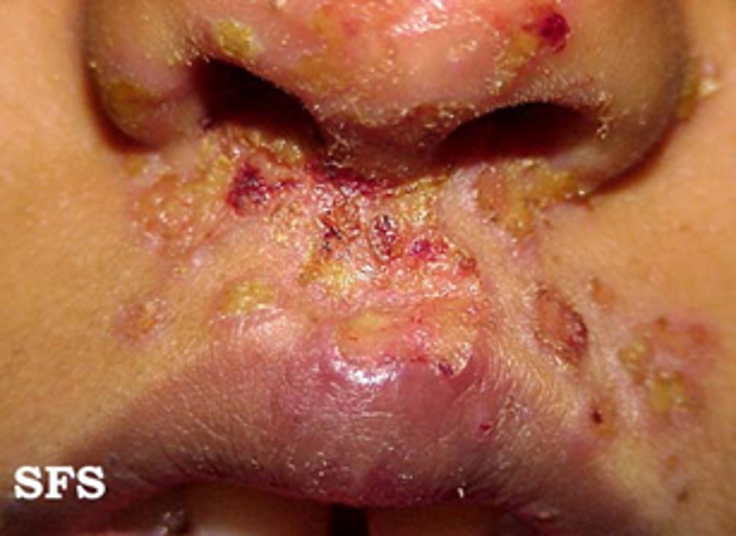 <p>dried serum, blood, or purulent exudate slightly elevated, size varies, brown, red, black, tan or straw in color</p>