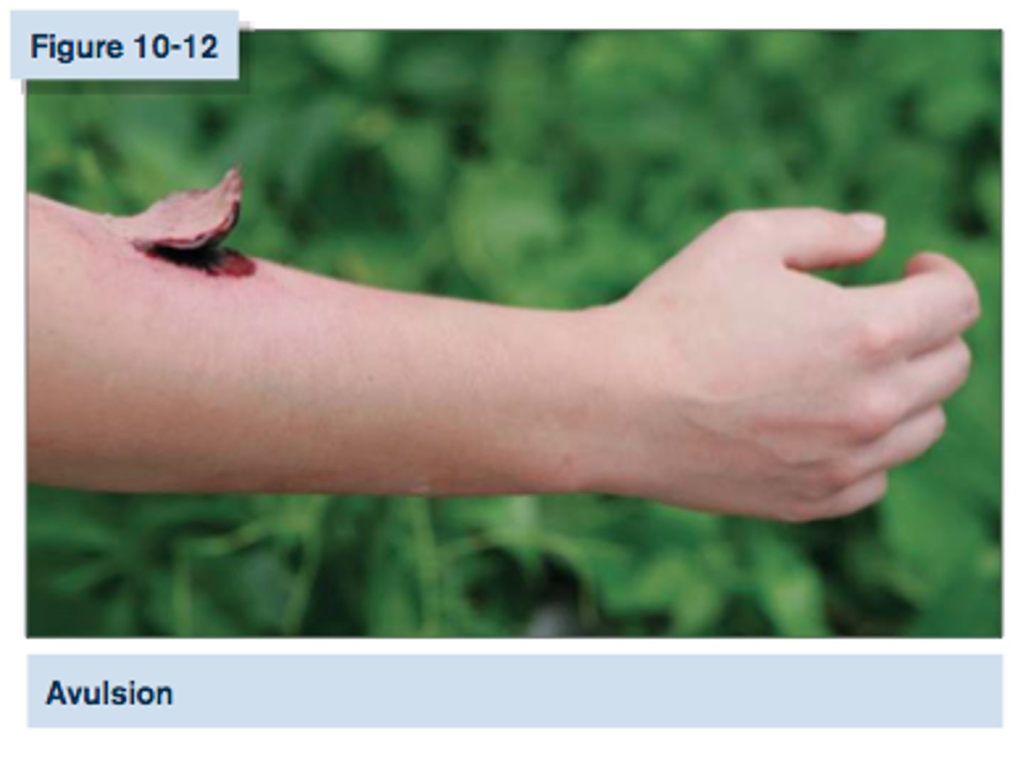 <p>Avulsion</p>