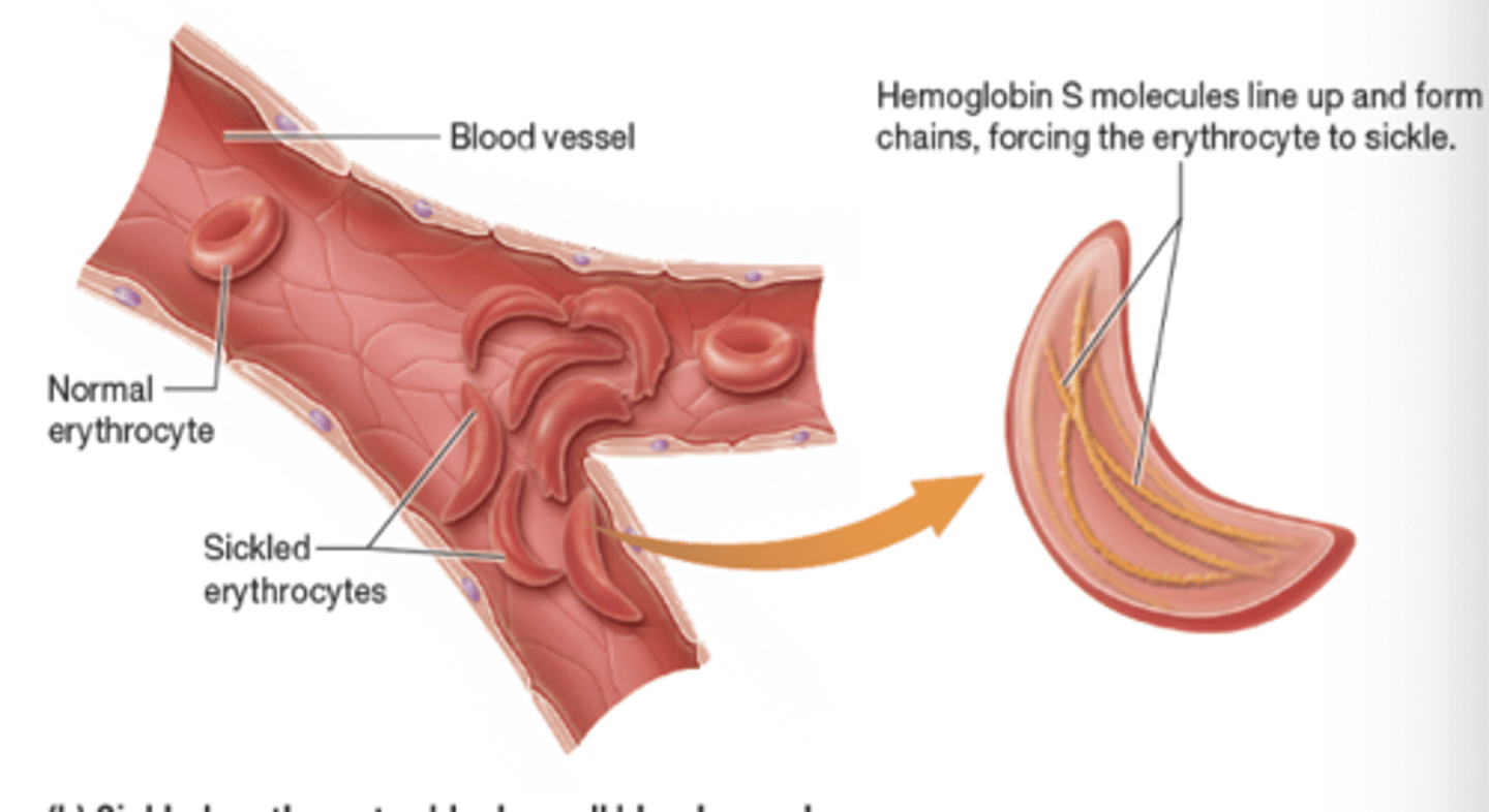 <p>oxygen levels are low, RBCs containing HbS change into sickle shape; leads to erythrocyte destruction in small blood vessels and reduction in circulating erythrocytes</p>