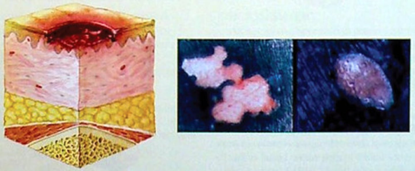 <p>- skin is not intact</p><p>- there partial -thickness skin loss of the epidermis or dermis</p><p>- ulcer is superficial and maybe an abrasion, a blister (open or fluid-filled, or a shallow crater)</p>