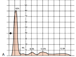 <p>Determine the condition of the patient given the serum electrophoresis graph</p><img src="https://knowt-user-attachments.s3.amazonaws.com/dff53fd5-e0fc-4828-8f80-0c7fab1b1fdf.png" data-width="100%" data-align="center" alt="knowt flashcard image"><p>A. Monoclonal gammopathy</p><p>B.&nbsp;α1 –antitrypsin deficiency</p><p>C.&nbsp;Inflammation </p><p>D.&nbsp;Liver Cirrhosis</p><p>E. NOTA</p>