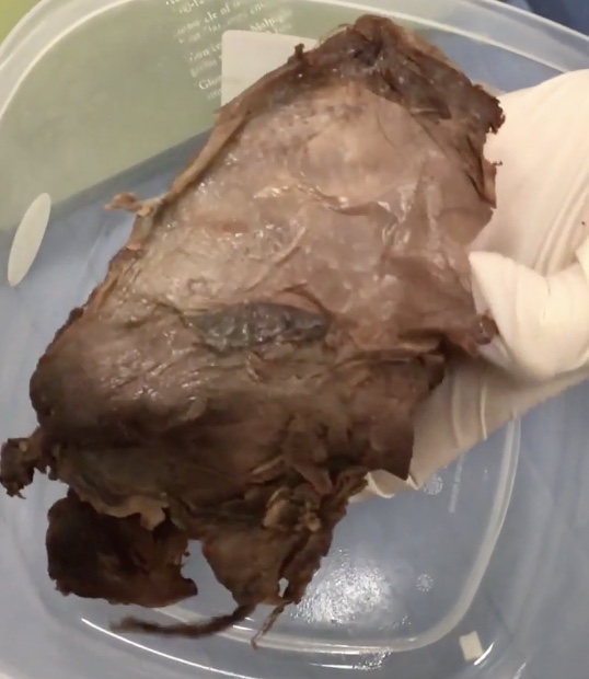 <p>Description: Inner, fibrous layer coating the kidney</p><p>Function: Maintains kidney shape and protects kidney from trauma</p>