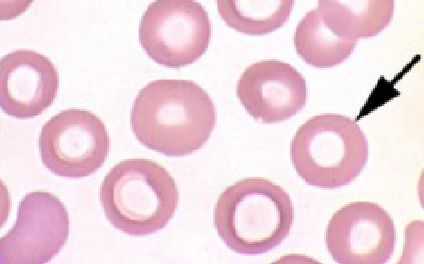 <ul><li><p>created by force of blood going through small vessels</p></li><li><p>area of central pallor </p></li></ul><p></p>