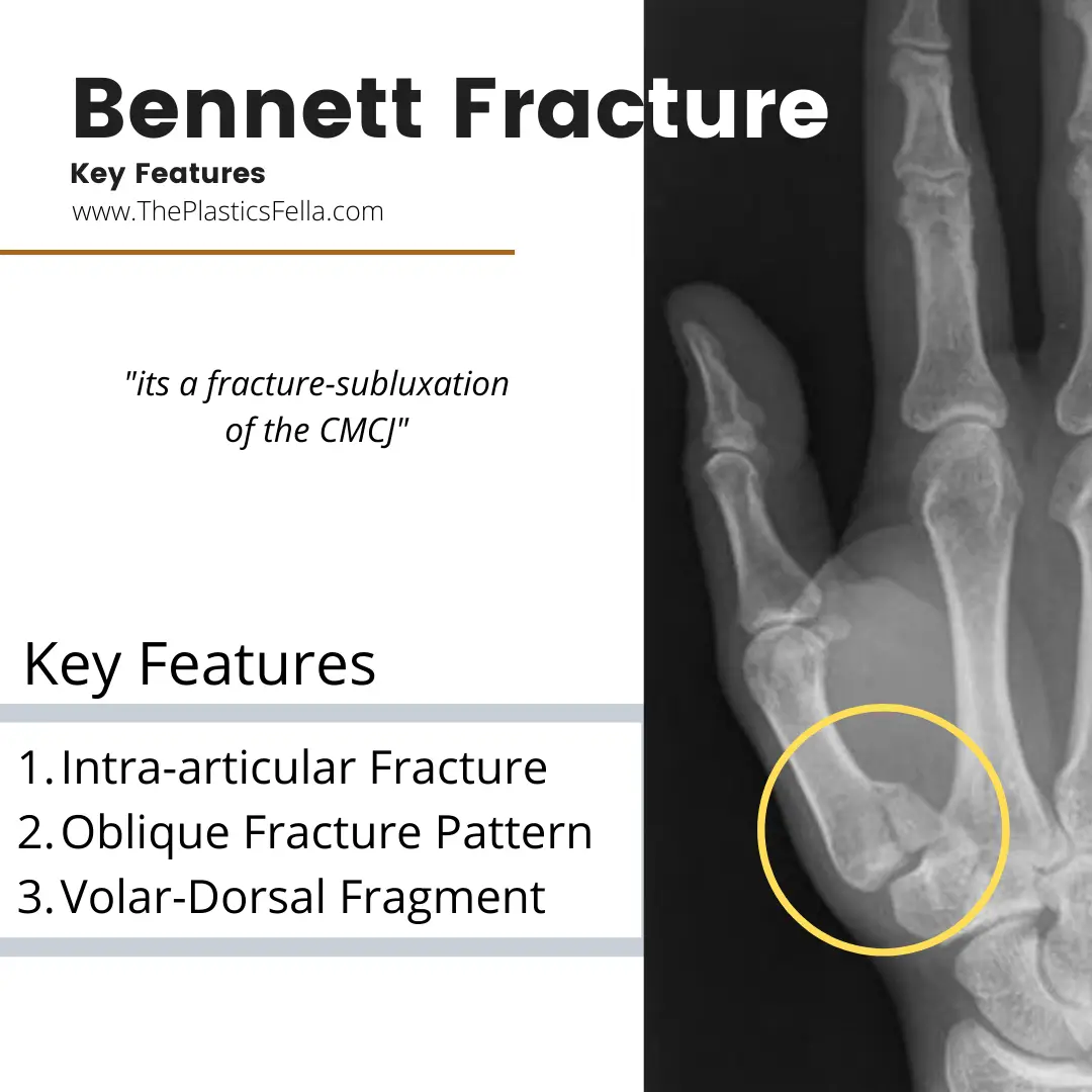 <p>punching, falls, bike riding, car crashes; can be accompanied by other injuries like trapezium fracture, or UCL injury at the MCP joint (which surgery may be necessary)</p><p>caused by axial loading on partially flexed 1st carpal-metacarpal joint (CMC) </p>