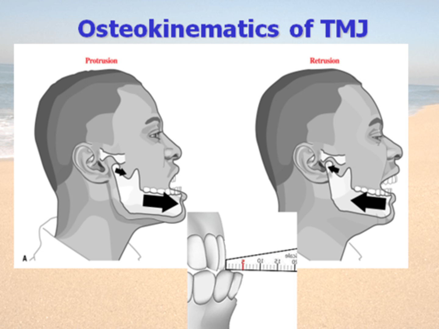 <p>Protrustion = &lt;8 mm</p><p>= depression </p><p>Retrusion = &lt;5 mm</p><p>= elevation </p>