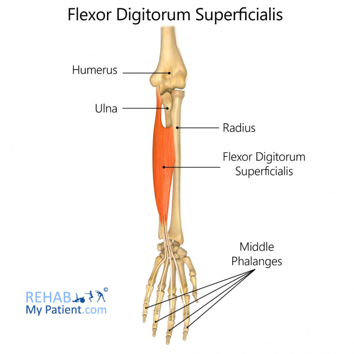 <p>m. flexor digitorum superficialis</p><p>origo:</p><p>caput humero-ulnare </p><ul><li><p>Epicondylus medialis</p></li></ul><p>Caput radiale</p><ul><li><p>Anterieure zijde radius</p></li></ul><p></p><p>insertio: basis midfalanx digiti 2-5</p><p>n. medianus</p>