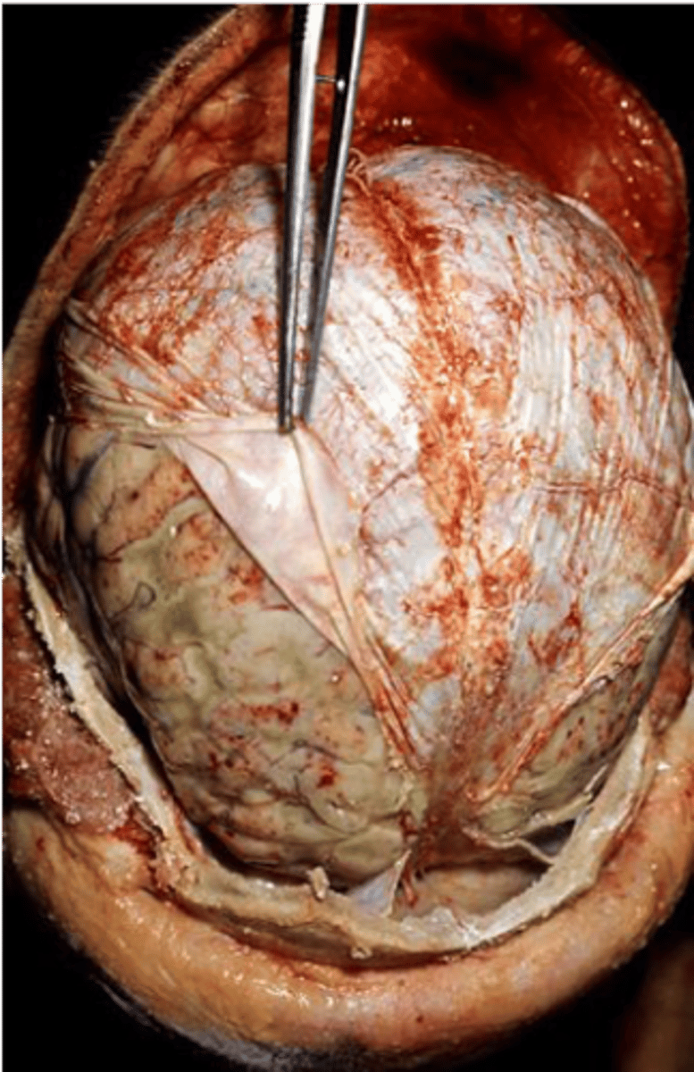 <p>-Streptococcus pneumoniae</p><p>-<strong>One of the 3 leading causes of bacterial meningitis</strong></p><p>-Meningitis may develop solely or follow pneumonia or otitis media (ear infection)</p><p>-Headache, stiff neck, fever, photophobia, irritability</p>