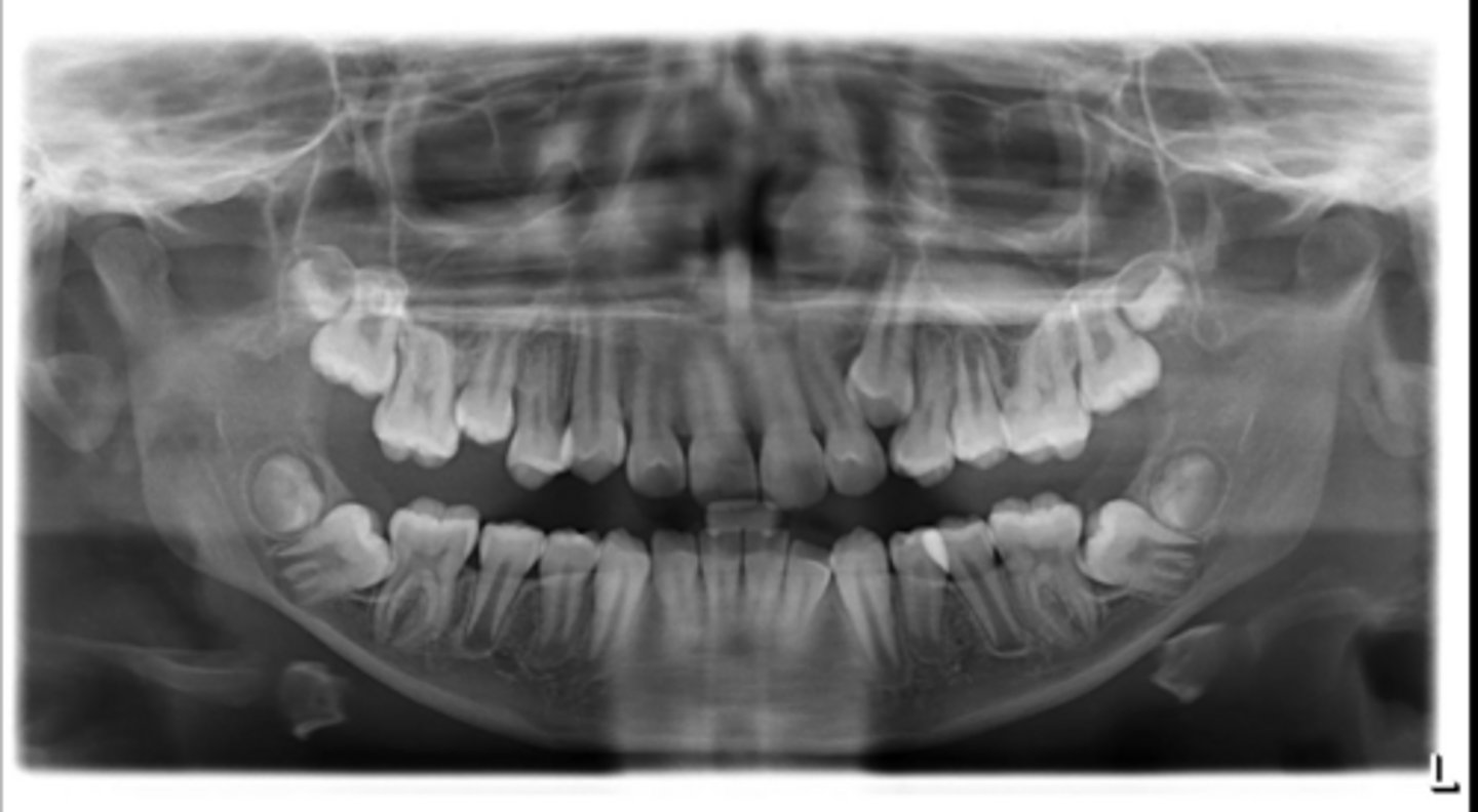 <p>Any impacted teeth?</p>
