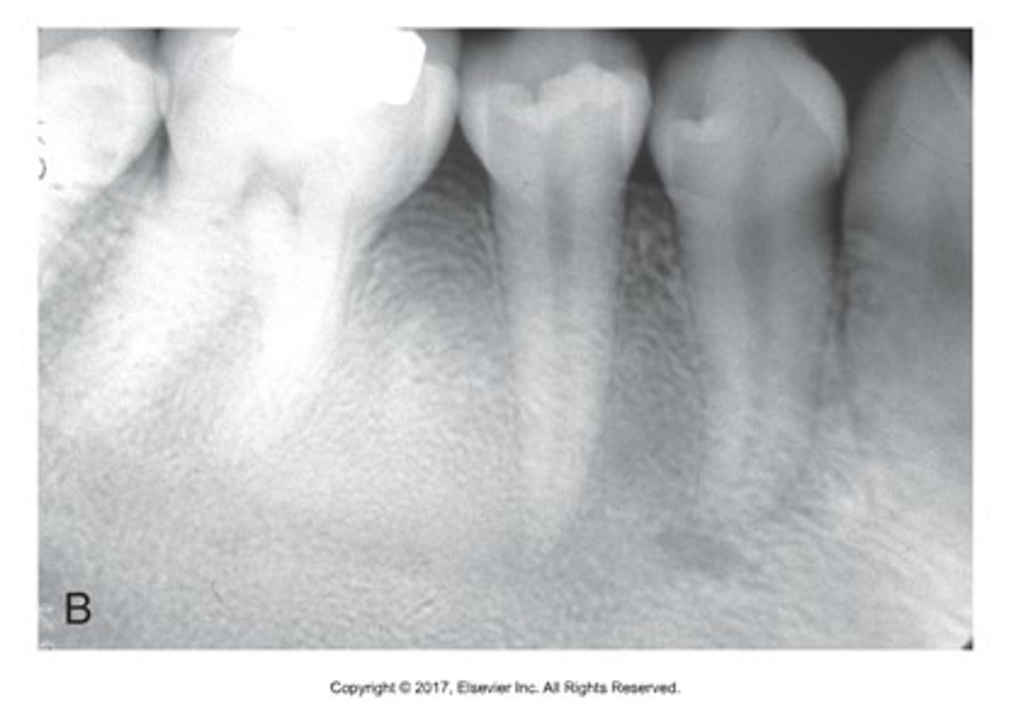 <p>granular or pebbled radiopacity, resembling pulverized glass. Gives an "Orange Peel" appearance.</p>