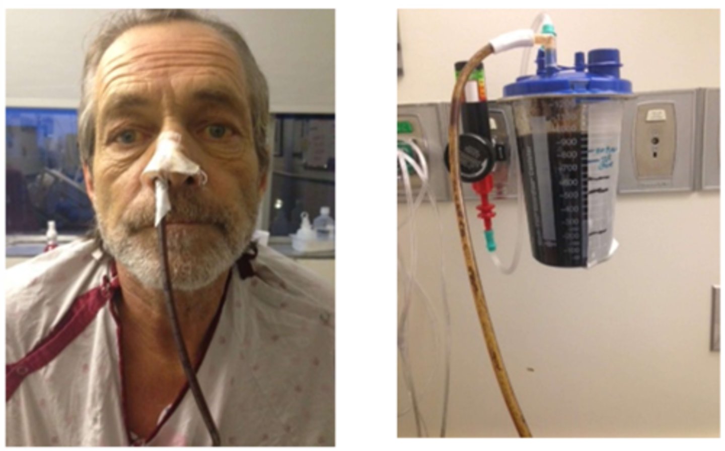 <p>Post-op lower GI procedure.</p>